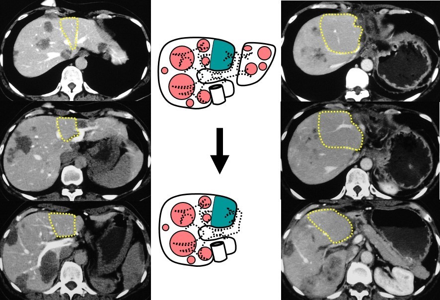 多段階肝切除の絵1.jpg