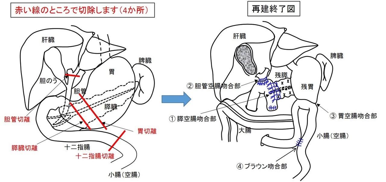 膵頭十二指腸切除.jpg