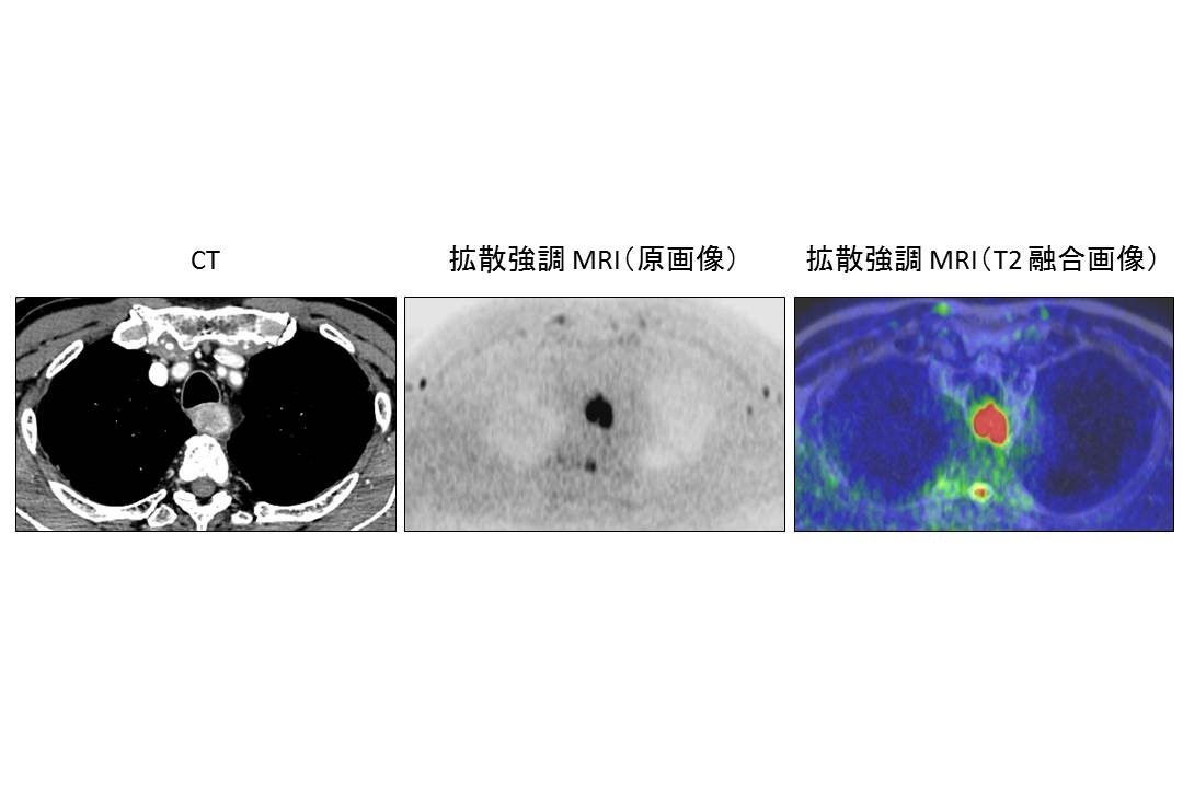 食道CT_MRI図５.jpg