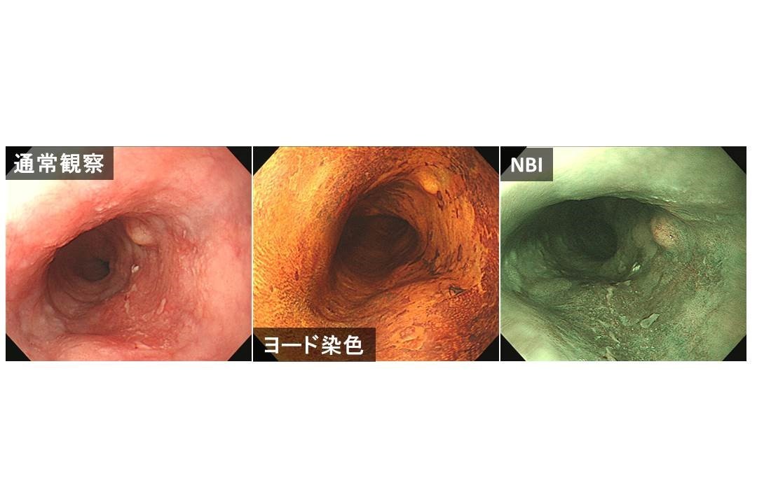食道内視鏡写真図３.jpg