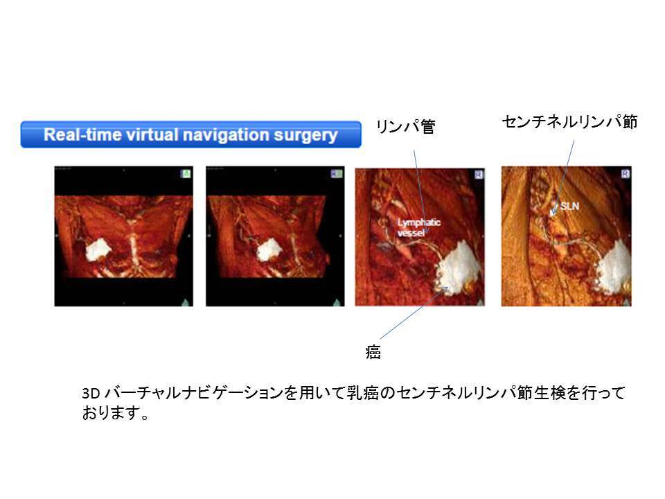 乳癌　３D.jpg