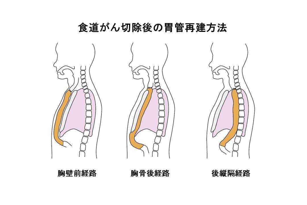 食道再建法図９.jpg