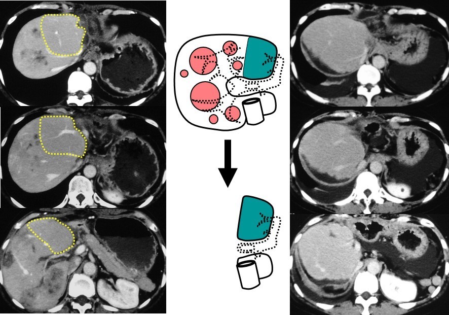 多段階肝切除の絵2.jpg