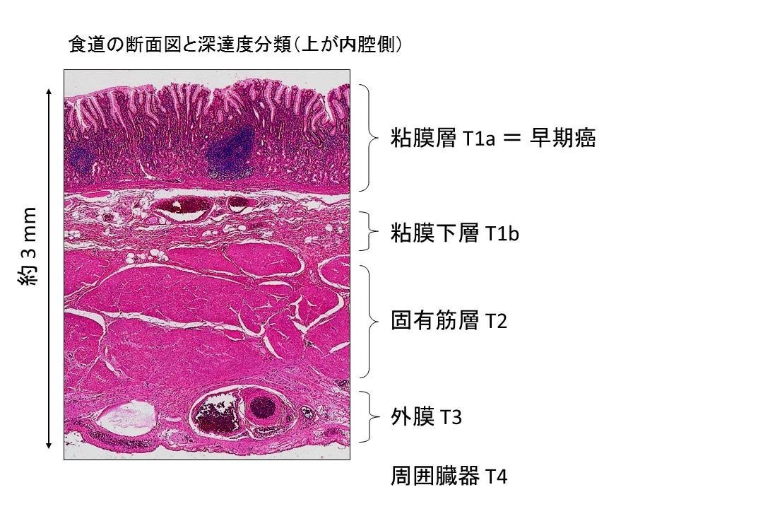 食道深達度HE図７.jpg